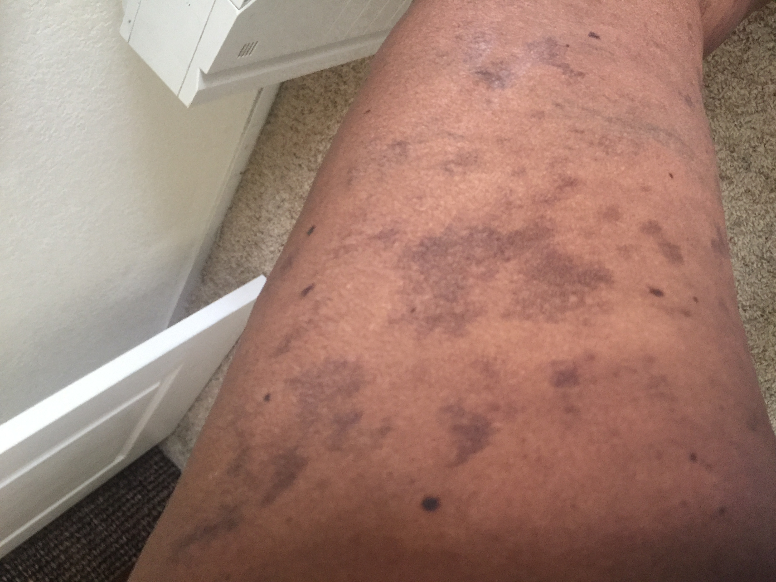 Suggest Management For Hyper-Pigmented Skin Lesions